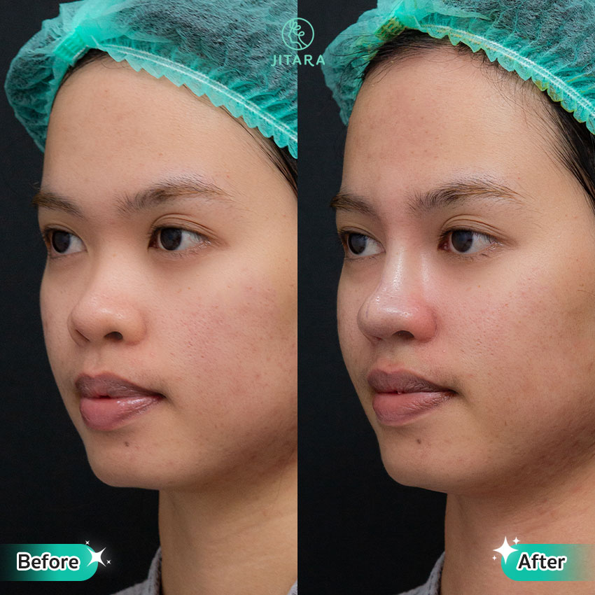 รีวิว เสริมจมูก ที่ Jitara Clinic ศูนย์รวมศัลยกรรมสุขภาพ และความงามครบวงจร