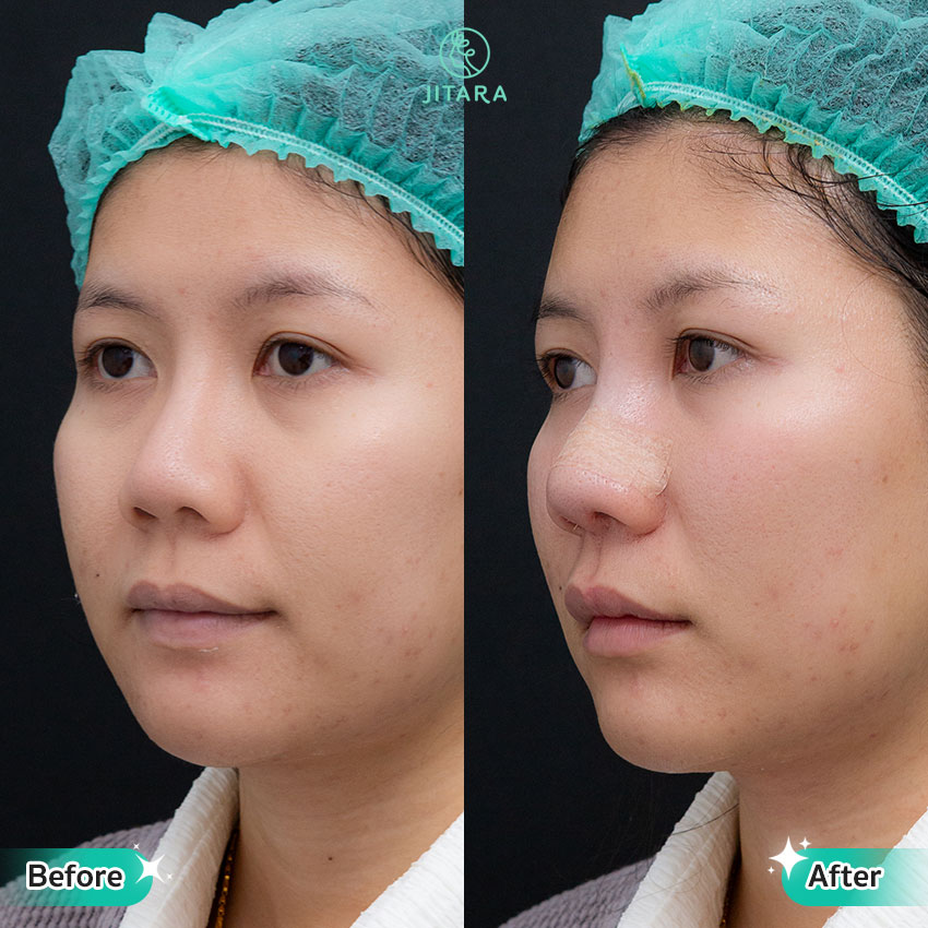 รีวิว เสริมจมูก ที่ Jitara Clinic ศูนย์รวมศัลยกรรมสุขภาพ และความงามครบวงจร