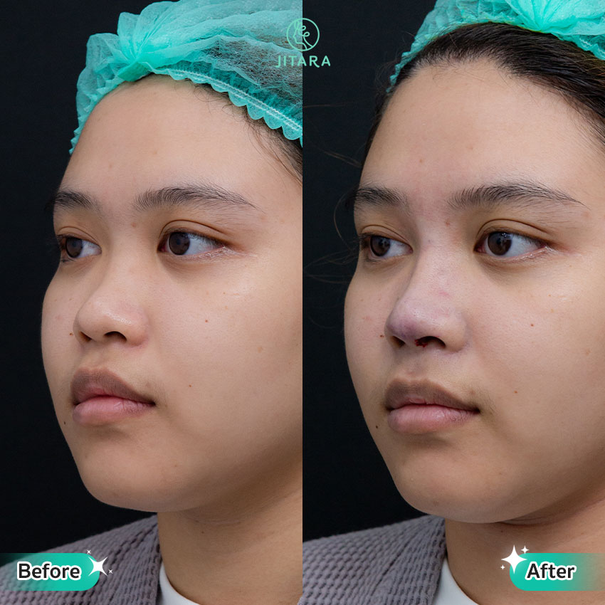รีวิว เสริมจมูก ที่ Jitara Clinic ศูนย์รวมศัลยกรรมสุขภาพ และความงามครบวงจร