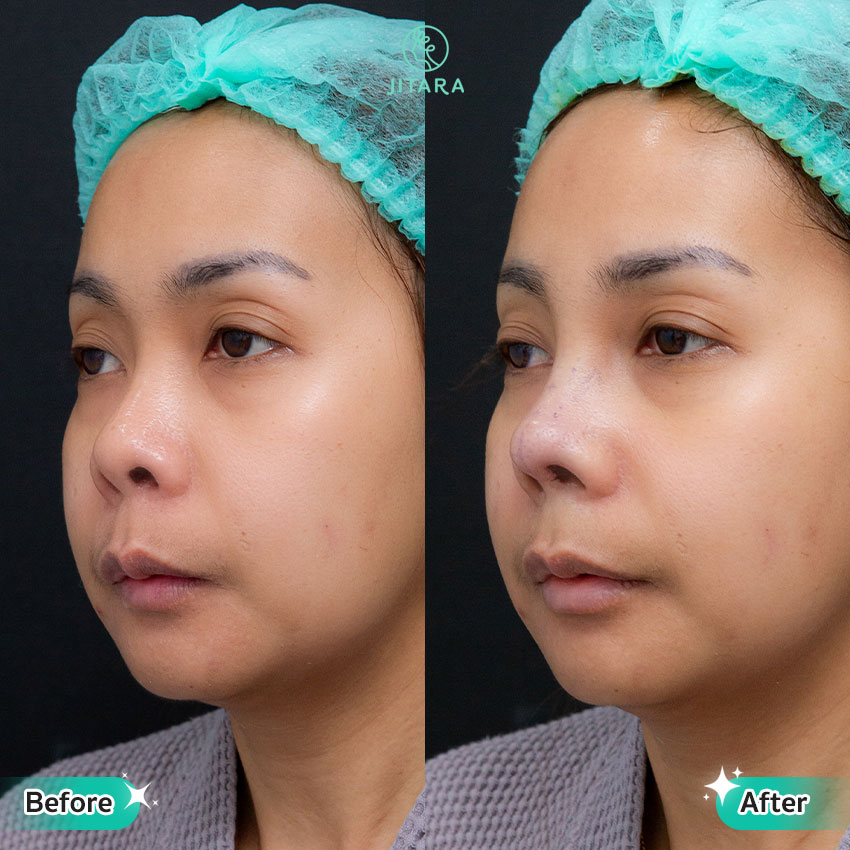 รีวิว เสริมจมูก ที่ Jitara Clinic ศูนย์รวมศัลยกรรมสุขภาพ และความงามครบวงจร