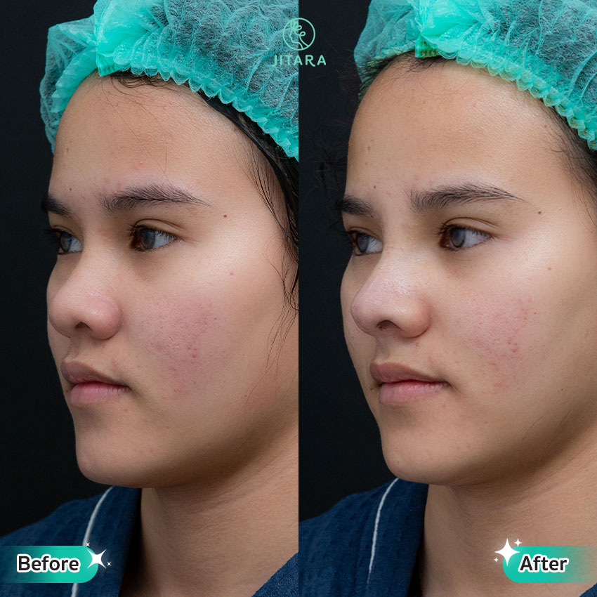 รีวิว เสริมจมูก ที่ Jitara Clinic ศูนย์รวมศัลยกรรมสุขภาพ และความงามครบวงจร