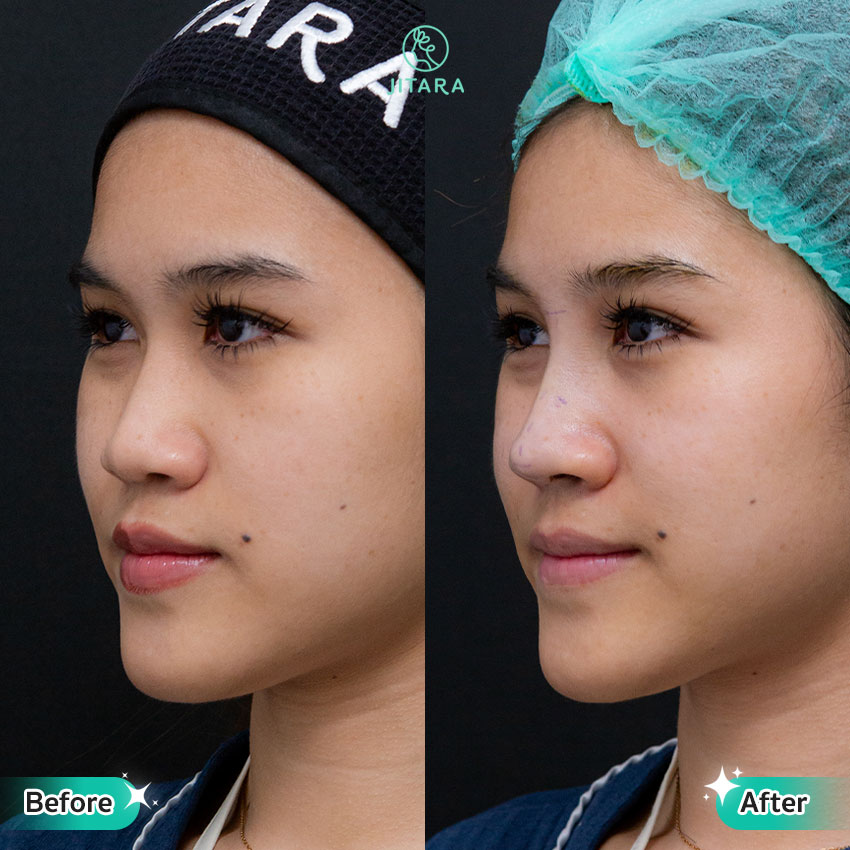 รีวิว เสริมจมูก ที่ Jitara Clinic ศูนย์รวมศัลยกรรมสุขภาพ และความงามครบวงจร