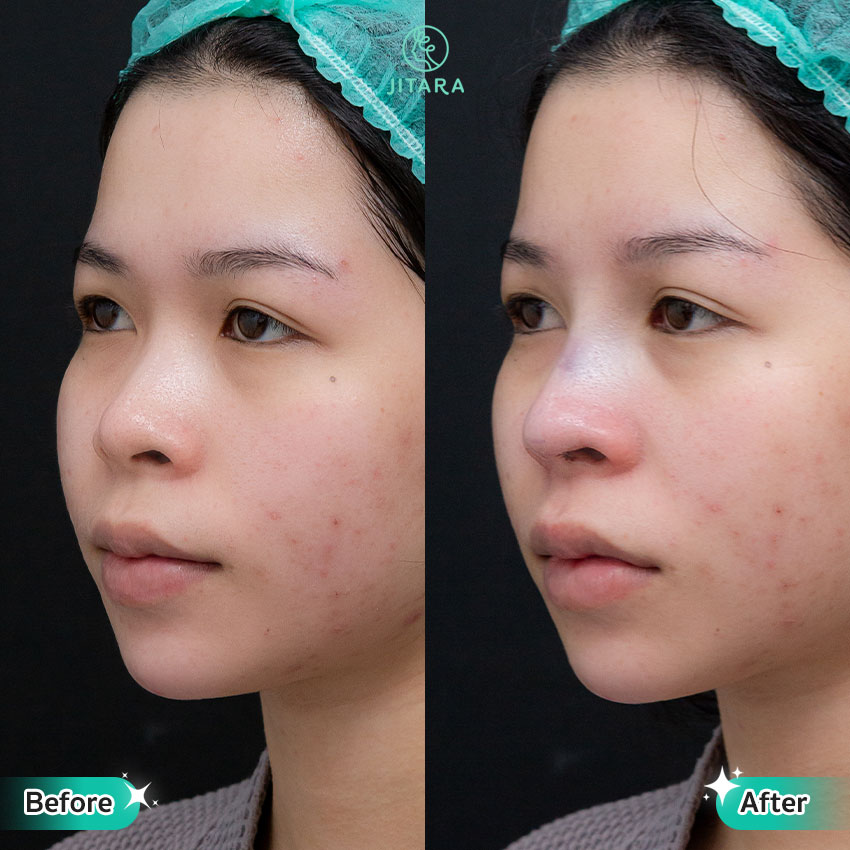 รีวิว เสริมจมูก ที่ Jitara Clinic ศูนย์รวมศัลยกรรมสุขภาพ และความงามครบวงจร