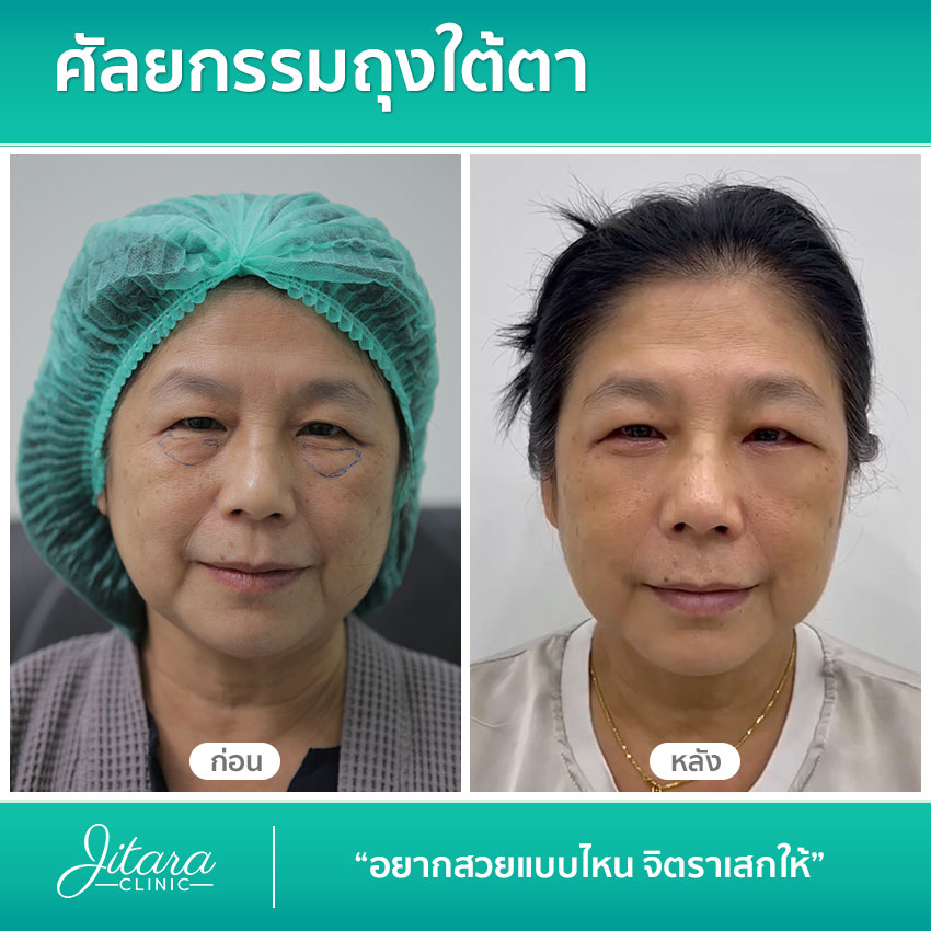 รีวิว ศัลยกรรมถุงใต้ตา