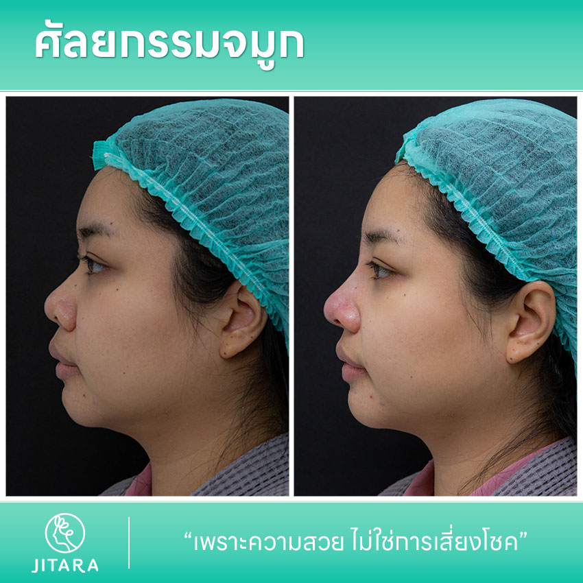 รีวิว เสริมจมูก ที่ Jitara Clinic ศูนย์รวมศัลยกรรมสุขภาพ และความงามครบวงจร