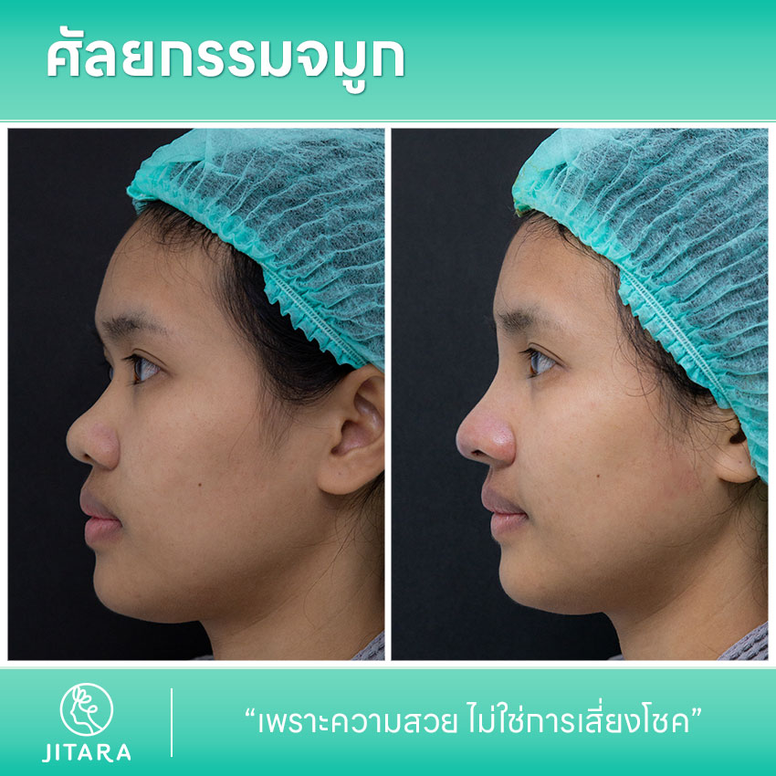 รีวิว เสริมจมูก ที่ Jitara Clinic ศูนย์รวมศัลยกรรมสุขภาพ และความงามครบวงจร