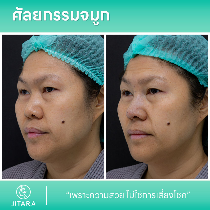 รีวิว เสริมจมูก ที่ Jitara Clinic ศูนย์รวมศัลยกรรมสุขภาพ และความงามครบวงจร