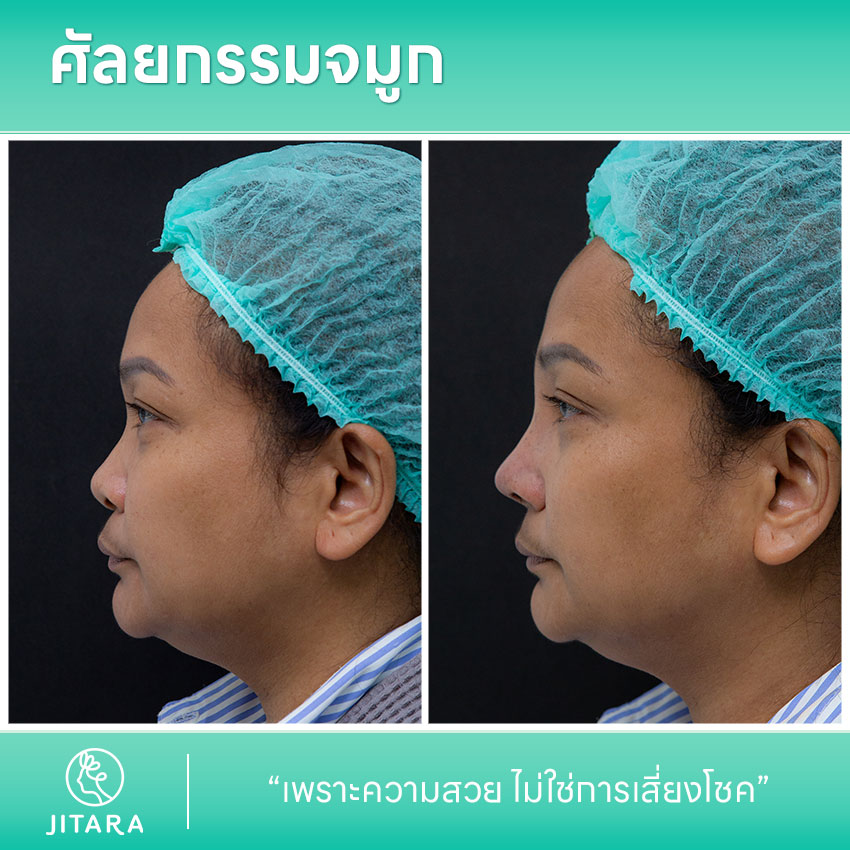 รีวิว เสริมจมูก ที่ Jitara Clinic ศูนย์รวมศัลยกรรมสุขภาพ และความงามครบวงจร