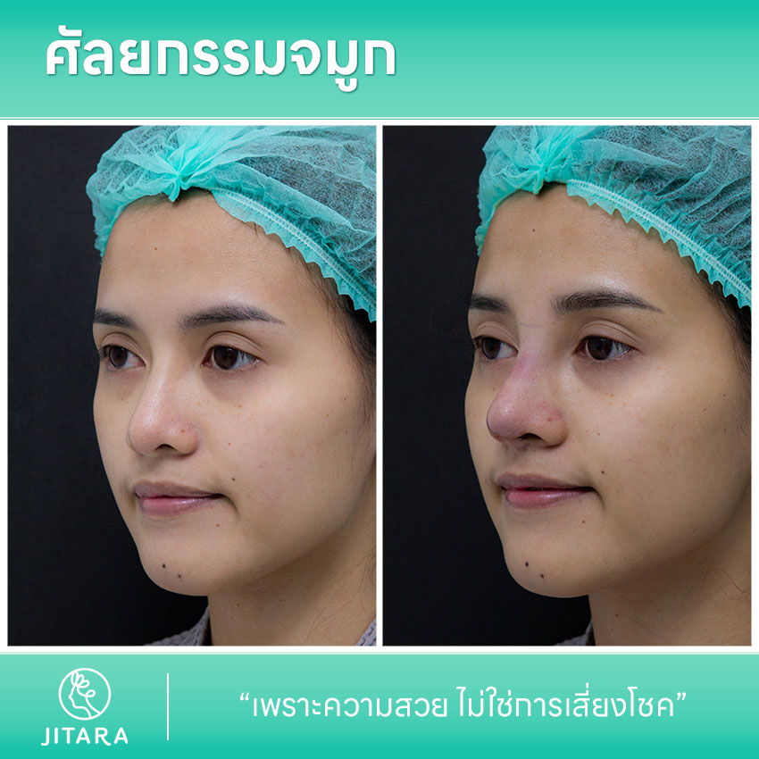รีวิว เสริมจมูก ที่ Jitara Clinic ศูนย์รวมศัลยกรรมสุขภาพ และความงามครบวงจร