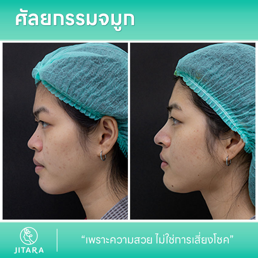 รีวิว เสริมจมูก ที่ Jitara Clinic ศูนย์รวมศัลยกรรมสุขภาพ และความงามครบวงจร