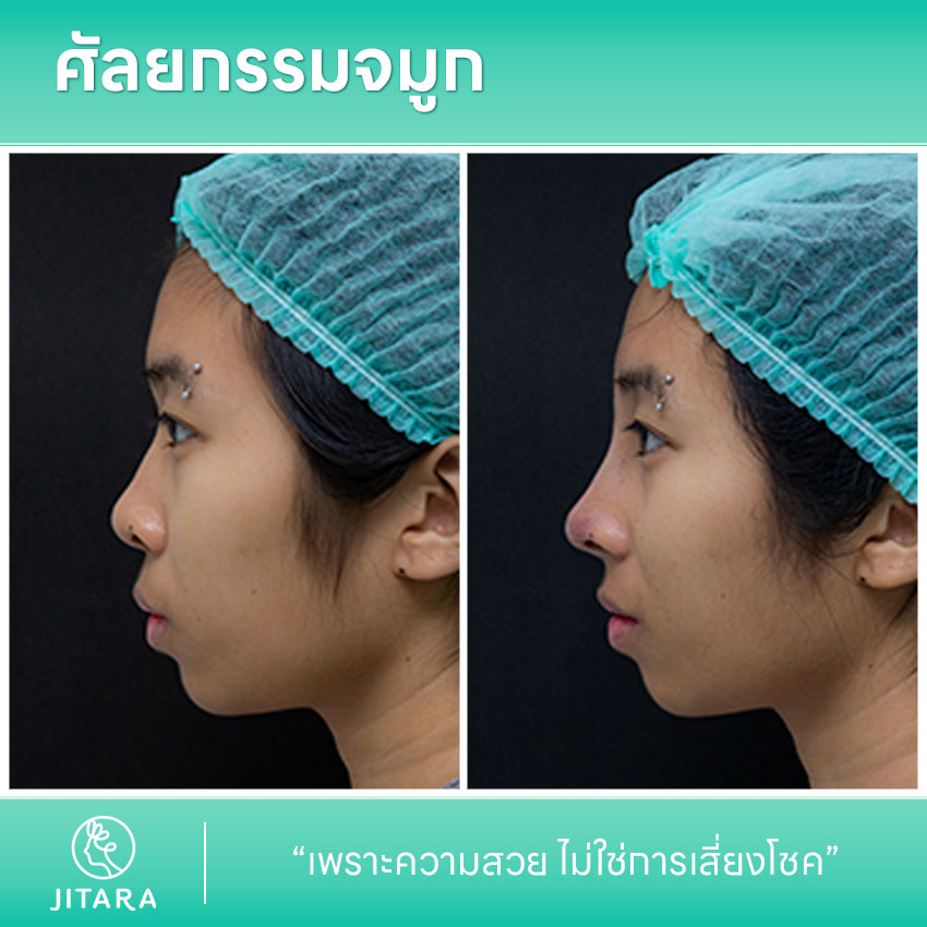 รีวิว เสริมจมูก ที่ Jitara Clinic ศูนย์รวมศัลยกรรมสุขภาพ และความงามครบวงจร