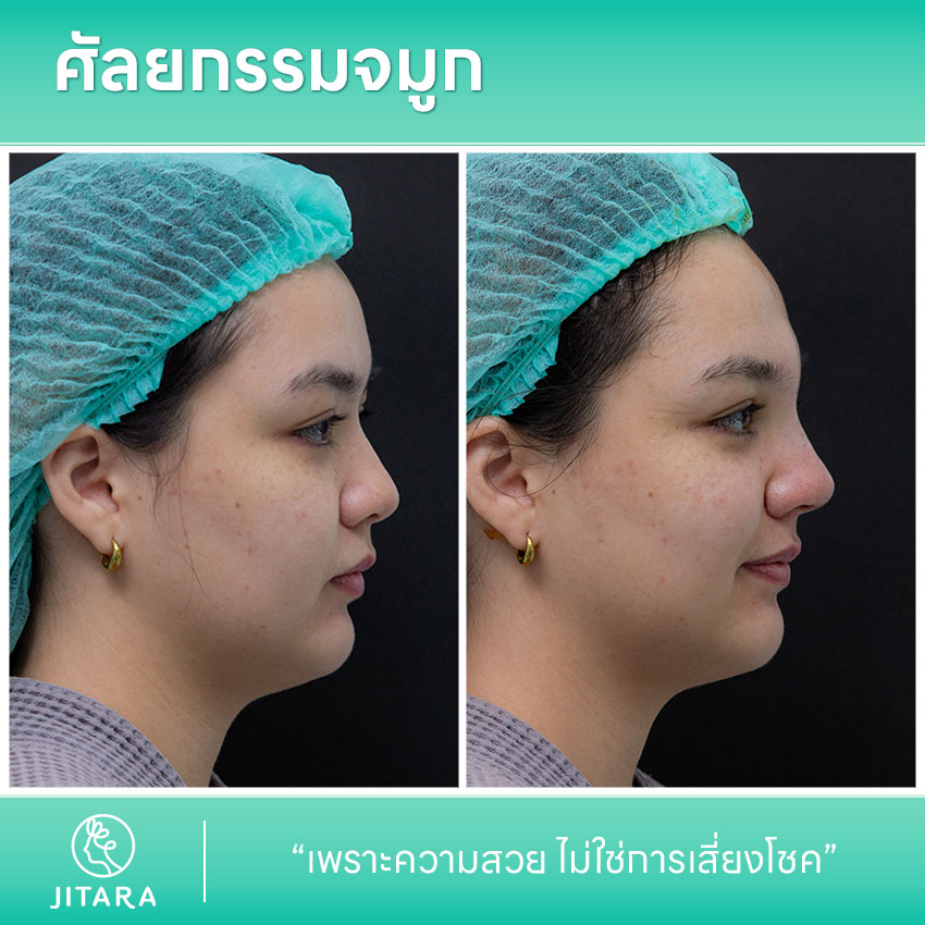 รีวิว เสริมจมูก ที่ Jitara Clinic ศูนย์รวมศัลยกรรมสุขภาพ และความงามครบวงจร