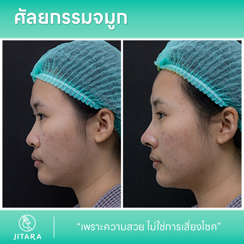 รีวิว เสริมจมูก ที่ Jitara Clinic ศูนย์รวมศัลยกรรมสุขภาพ และความงามครบวงจร