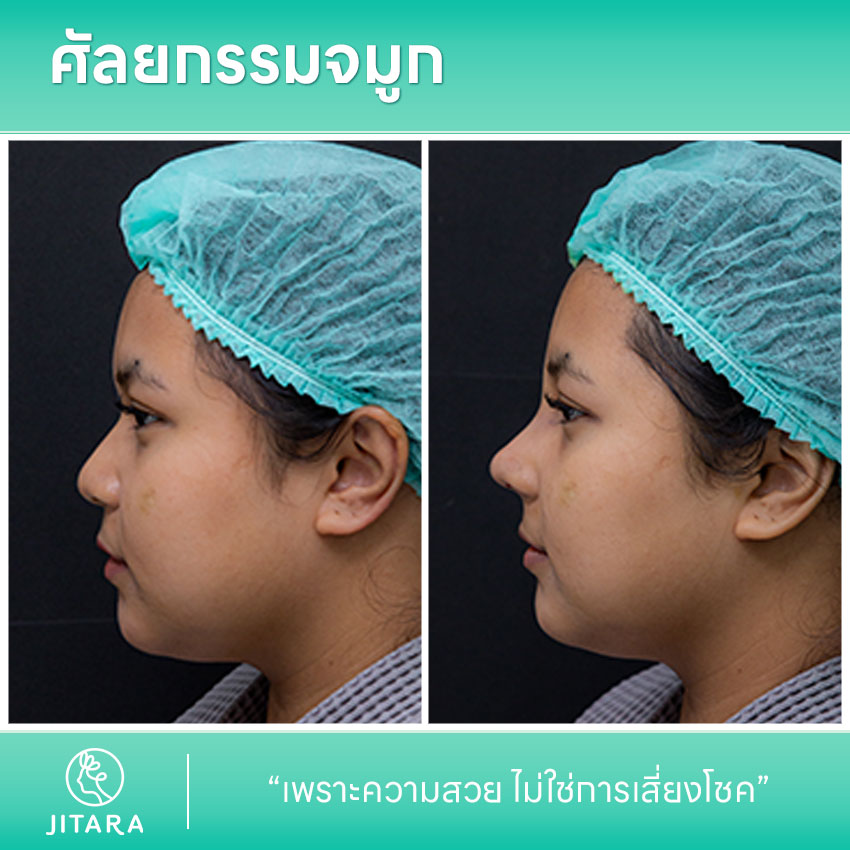 รีวิว เสริมจมูก ที่ Jitara Clinic ศูนย์รวมศัลยกรรมสุขภาพ และความงามครบวงจร