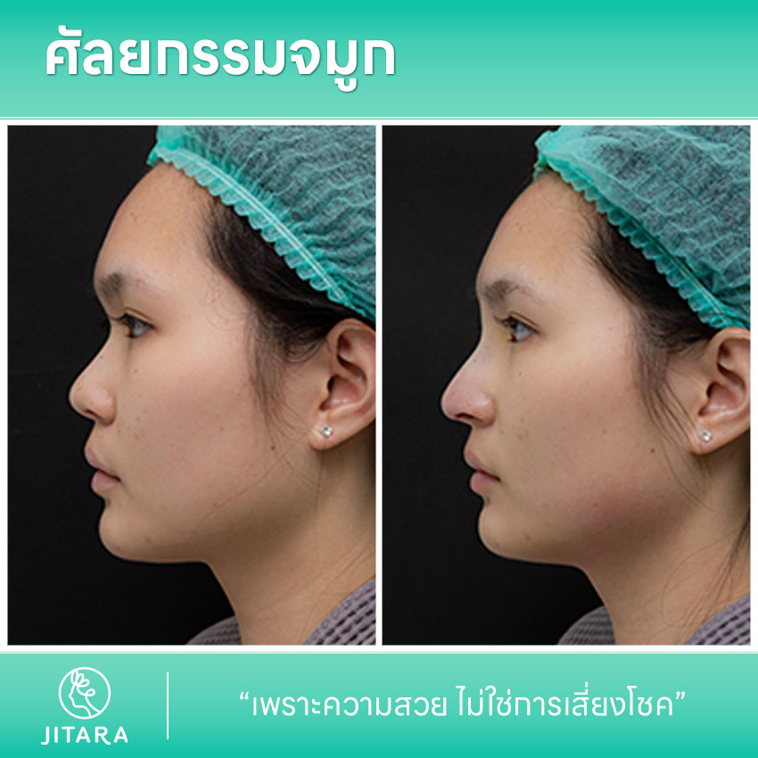 รีวิว เสริมจมูก ที่ Jitara Clinic ศูนย์รวมศัลยกรรมสุขภาพ และความงามครบวงจร