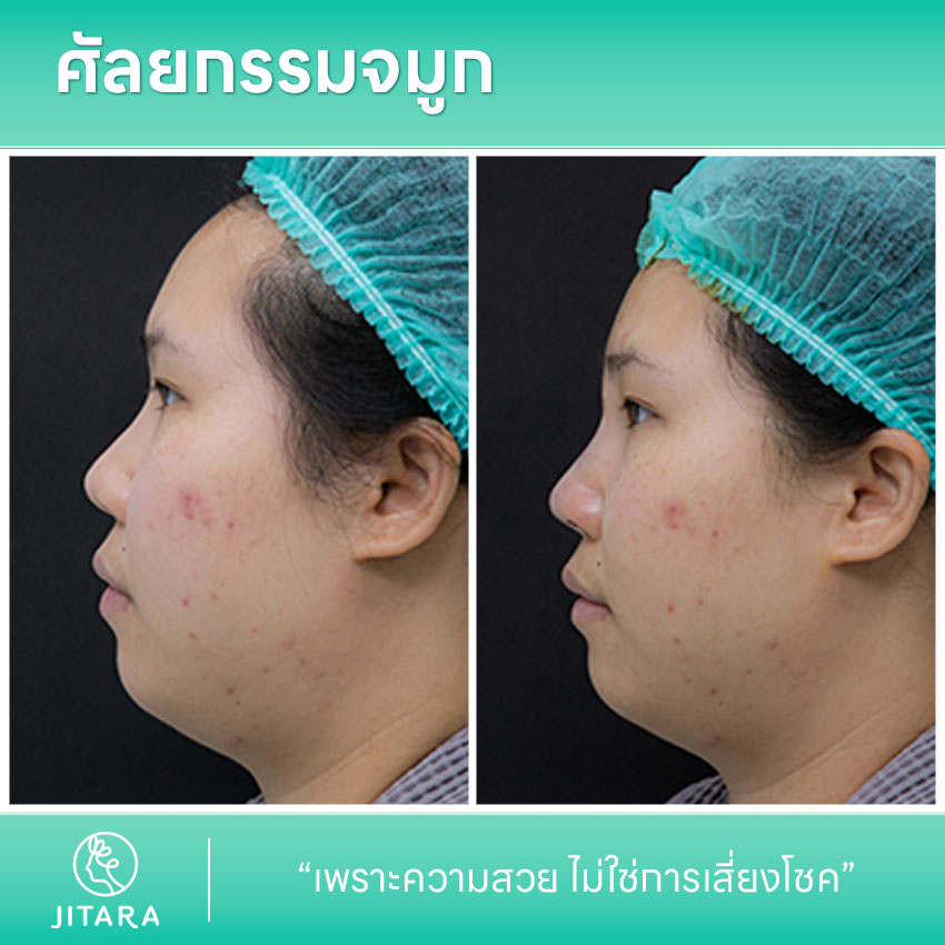 รีวิว เสริมจมูก ที่ Jitara Clinic ศูนย์รวมศัลยกรรมสุขภาพ และความงามครบวงจร