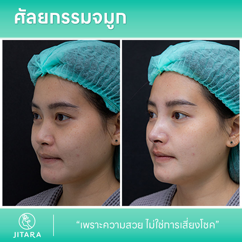 รีวิว เสริมจมูก ที่ Jitara Clinic ศูนย์รวมศัลยกรรมสุขภาพ และความงามครบวงจร