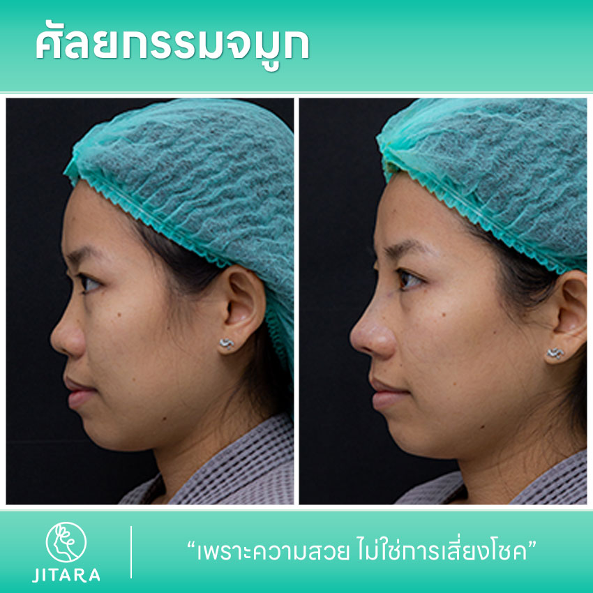 รีวิว เสริมจมูก ที่ Jitara Clinic ศูนย์รวมศัลยกรรมสุขภาพ และความงามครบวงจร