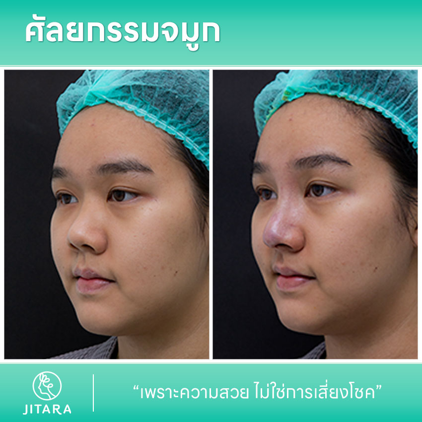 รีวิว เสริมจมูก ที่ Jitara Clinic ศูนย์รวมศัลยกรรมสุขภาพ และความงามครบวงจร