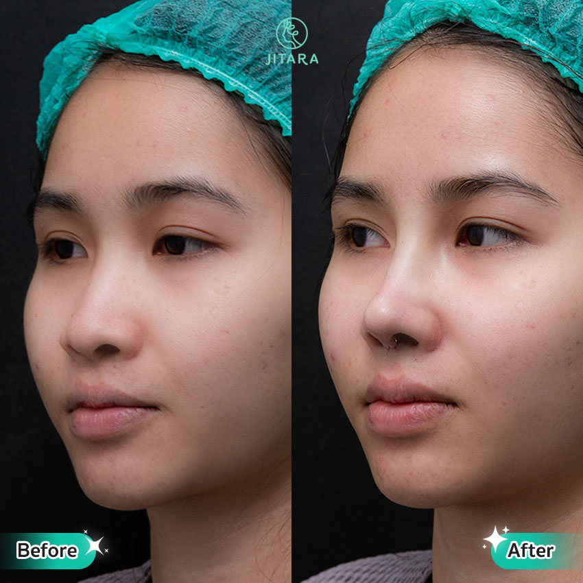 รีวิว เสริมจมูก ที่ Jitara Clinic ศูนย์รวมศัลยกรรมสุขภาพ และความงามครบวงจร
