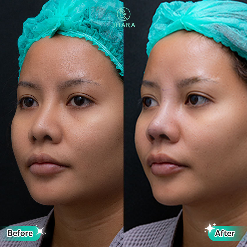 รีวิว เสริมจมูก ที่ Jitara Clinic ศูนย์รวมศัลยกรรมสุขภาพ และความงามครบวงจร