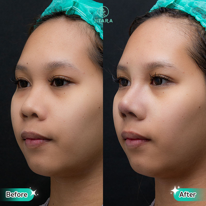 รีวิว เสริมจมูก ที่ Jitara Clinic ศูนย์รวมศัลยกรรมสุขภาพ และความงามครบวงจร