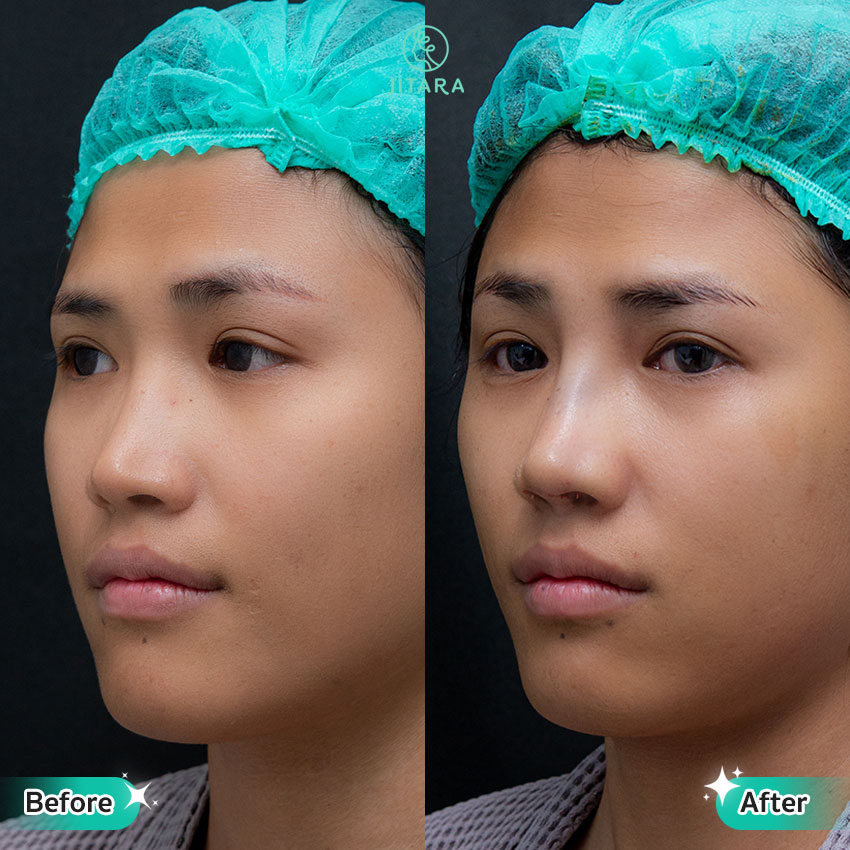รีวิว เสริมจมูก ที่ Jitara Clinic ศูนย์รวมศัลยกรรมสุขภาพ และความงามครบวงจร