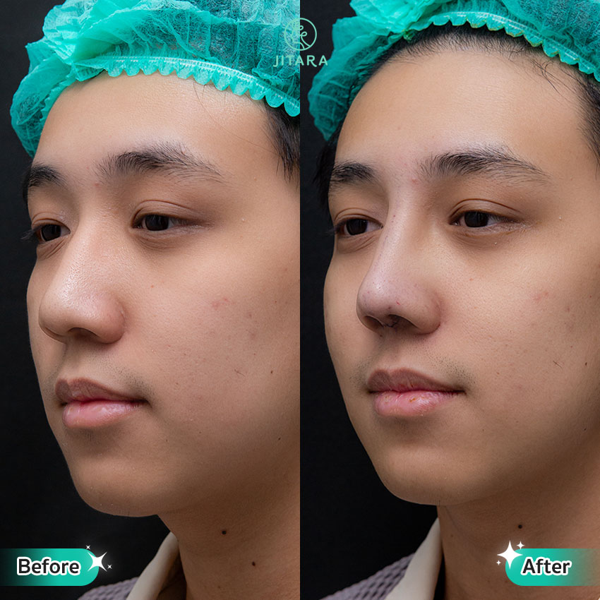 รีวิว เสริมจมูก ที่ Jitara Clinic ศูนย์รวมศัลยกรรมสุขภาพ และความงามครบวงจร