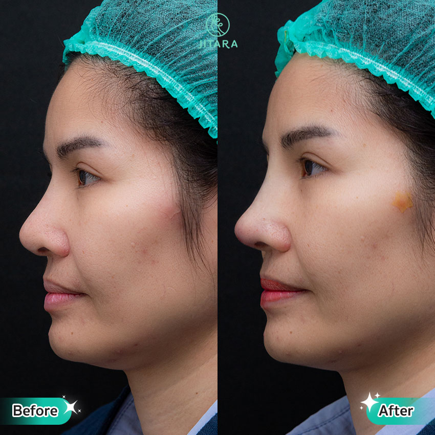 รีวิว เสริมจมูก ที่ Jitara Clinic ศูนย์รวมศัลยกรรมสุขภาพ และความงามครบวงจร