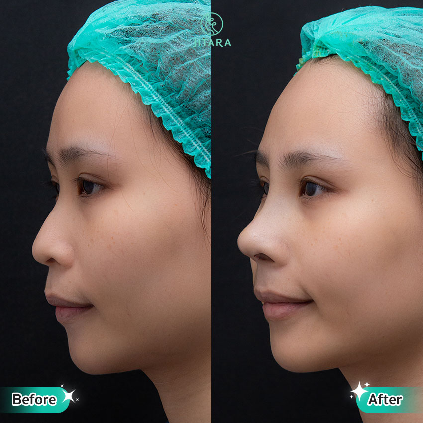 รีวิว เสริมจมูก ที่ Jitara Clinic ศูนย์รวมศัลยกรรมสุขภาพ และความงามครบวงจร