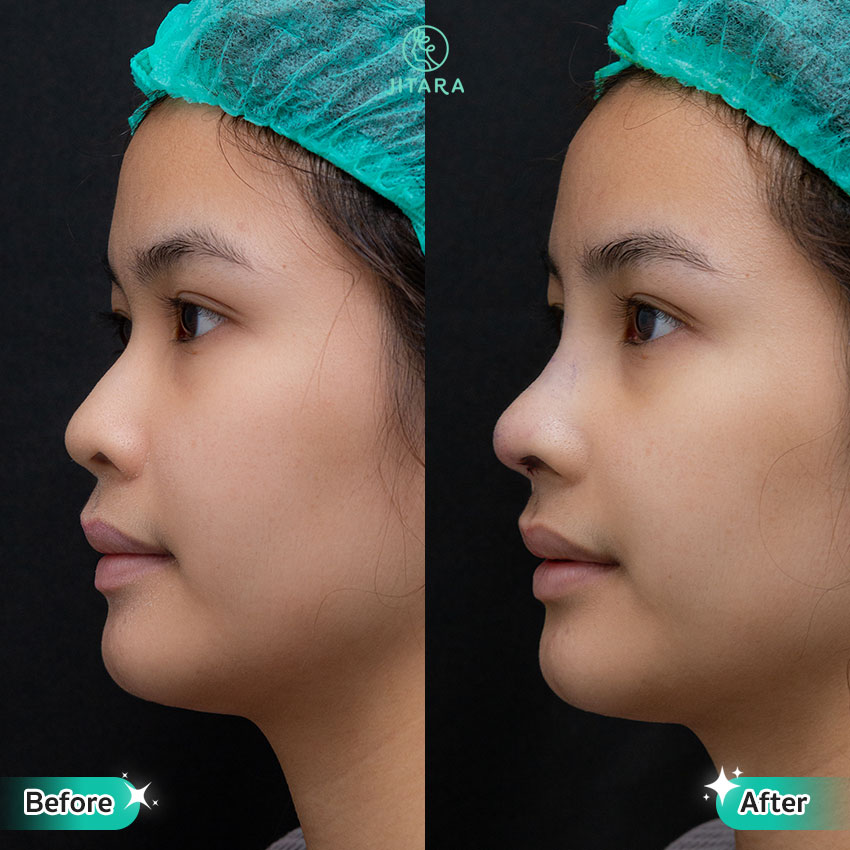 รีวิว เสริมจมูก ที่ Jitara Clinic ศูนย์รวมศัลยกรรมสุขภาพ และความงามครบวงจร