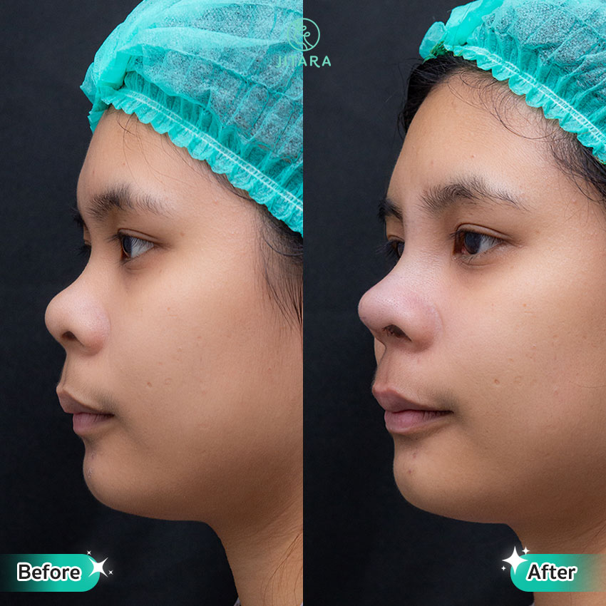 รีวิว เสริมจมูก ที่ Jitara Clinic ศูนย์รวมศัลยกรรมสุขภาพ และความงามครบวงจร