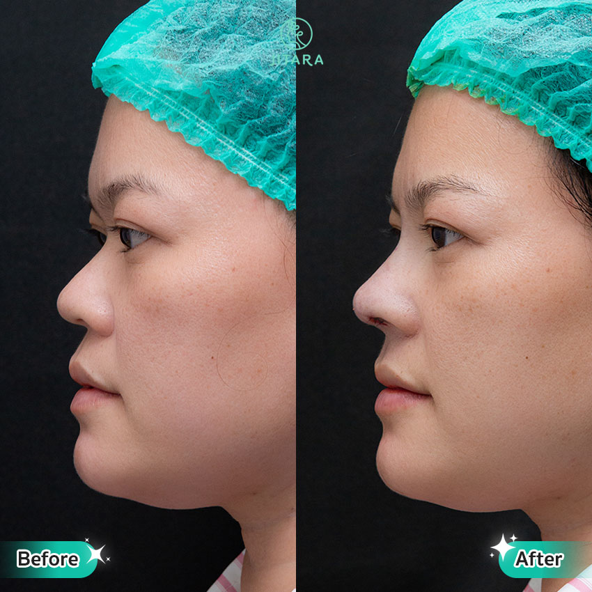 รีวิว เสริมจมูก ที่ Jitara Clinic ศูนย์รวมศัลยกรรมสุขภาพ และความงามครบวงจร