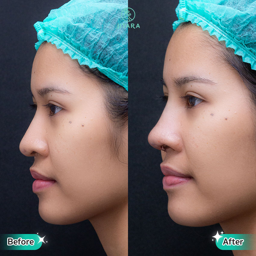 รีวิว เสริมจมูก ที่ Jitara Clinic ศูนย์รวมศัลยกรรมสุขภาพ และความงามครบวงจร