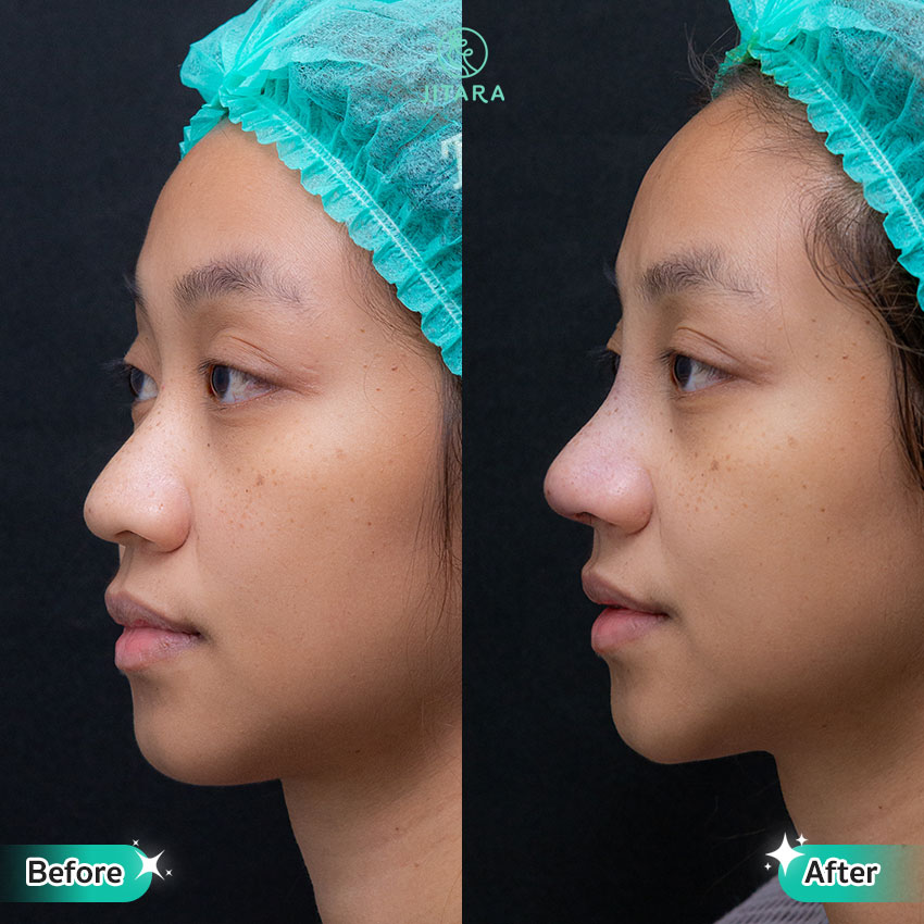 รีวิว เสริมจมูก ที่ Jitara Clinic ศูนย์รวมศัลยกรรมสุขภาพ และความงามครบวงจร