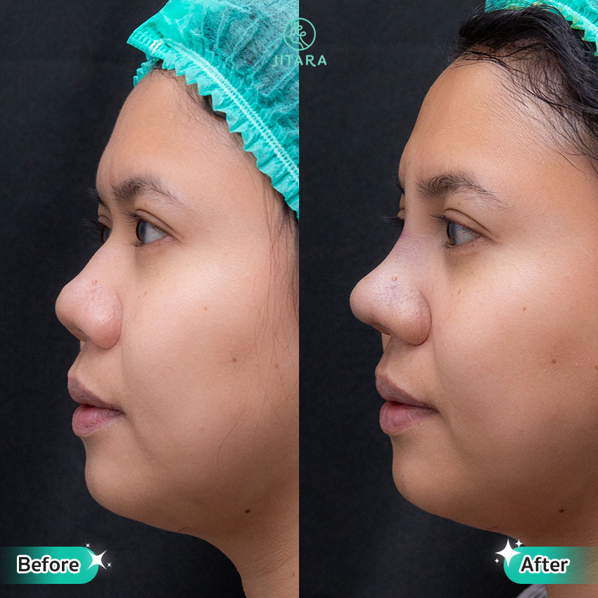 รีวิว เสริมจมูก ที่ Jitara Clinic ศูนย์รวมศัลยกรรมสุขภาพ และความงามครบวงจร
