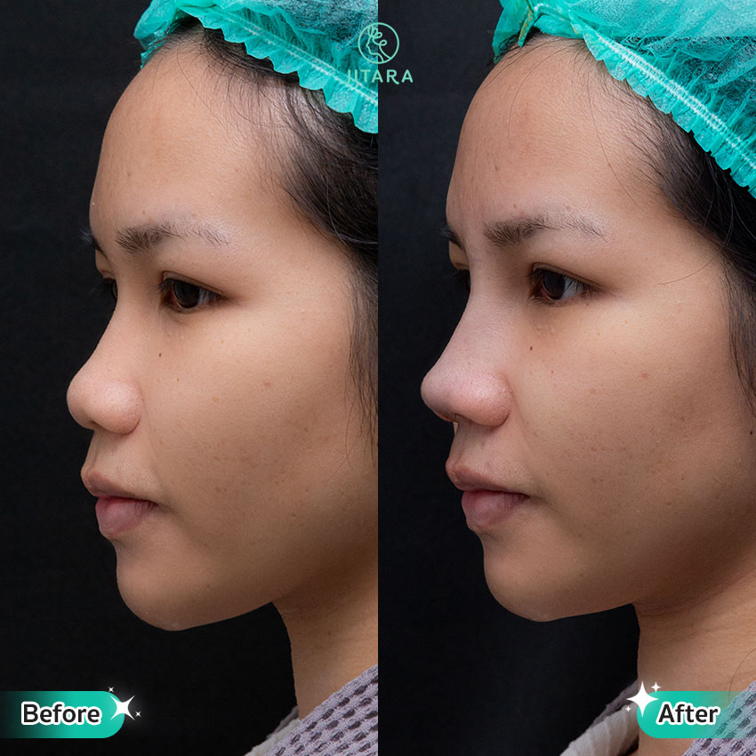 รีวิว เสริมจมูก ที่ Jitara Clinic ศูนย์รวมศัลยกรรมสุขภาพ และความงามครบวงจร