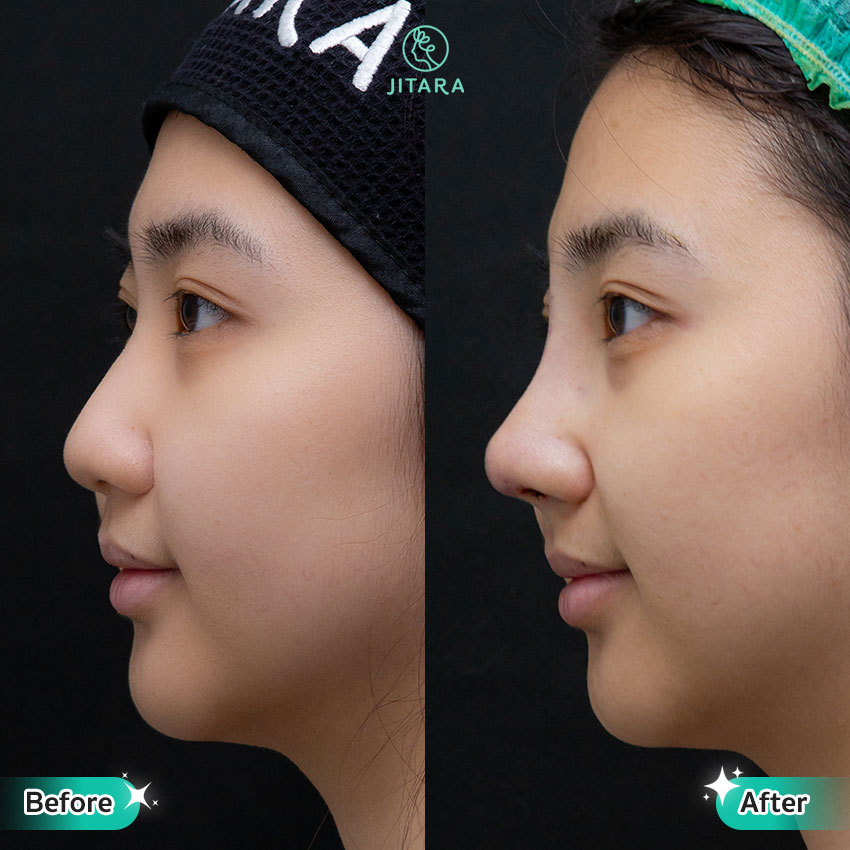 รีวิว เสริมจมูก ที่ Jitara Clinic ศูนย์รวมศัลยกรรมสุขภาพ และความงามครบวงจร