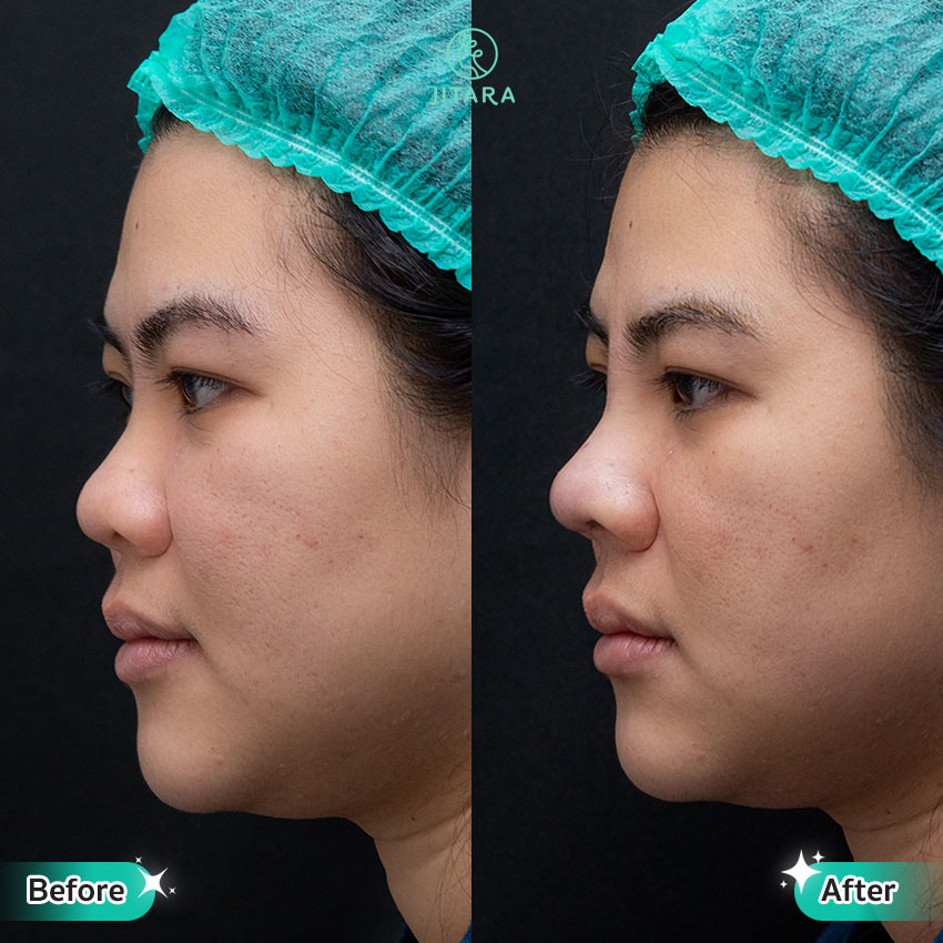 รีวิว เสริมจมูก ที่ Jitara Clinic ศูนย์รวมศัลยกรรมสุขภาพ และความงามครบวงจร