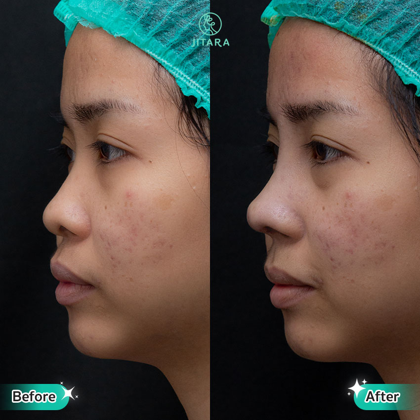 รีวิว เสริมจมูก ที่ Jitara Clinic ศูนย์รวมศัลยกรรมสุขภาพ และความงามครบวงจร