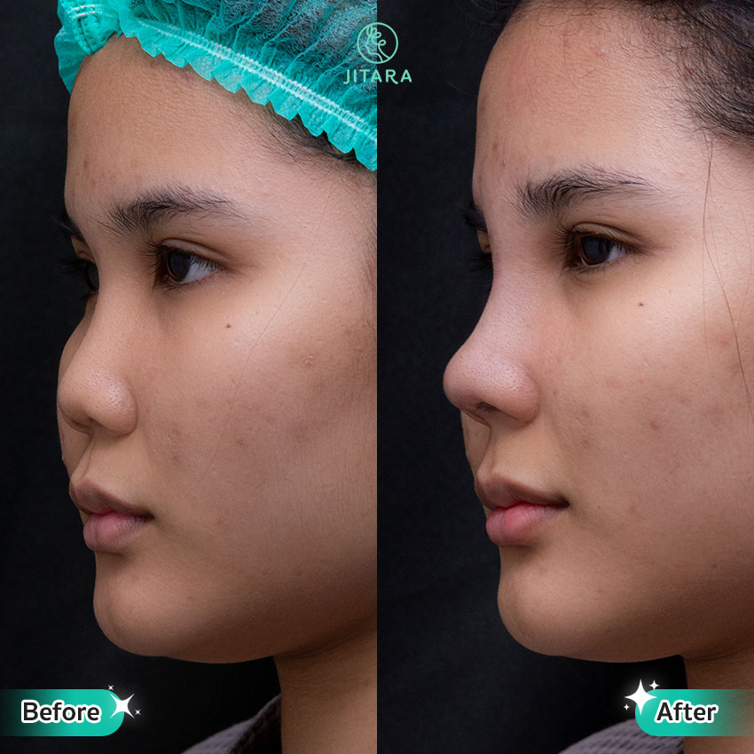 รีวิว เสริมจมูก ที่ Jitara Clinic ศูนย์รวมศัลยกรรมสุขภาพ และความงามครบวงจร
