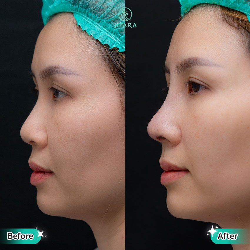รีวิว เสริมจมูก ที่ Jitara Clinic ศูนย์รวมศัลยกรรมสุขภาพ และความงามครบวงจร