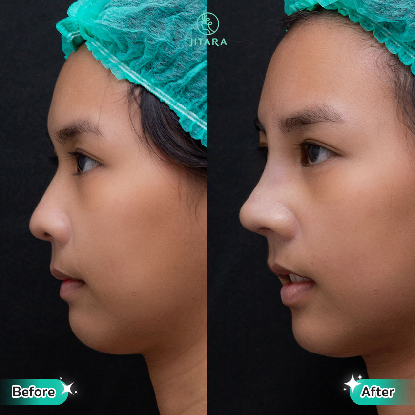 รีวิว เสริมจมูก ที่ Jitara Clinic ศูนย์รวมศัลยกรรมสุขภาพ และความงามครบวงจร