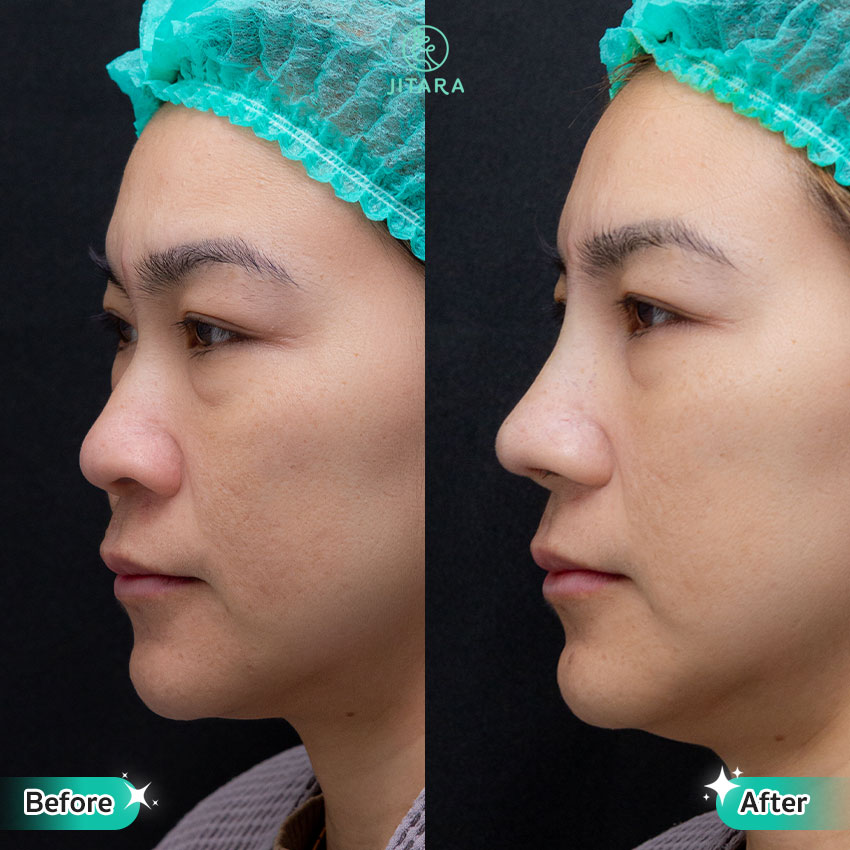 รีวิว เสริมจมูก ที่ Jitara Clinic ศูนย์รวมศัลยกรรมสุขภาพ และความงามครบวงจร