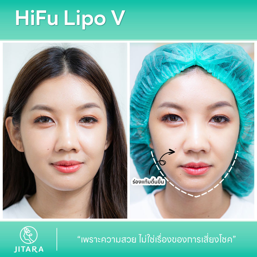 รีวิว Hifu Lipo V | jitaraclinic