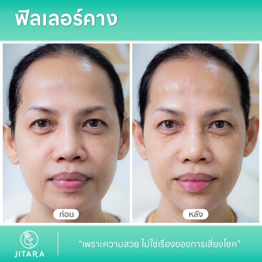 ฟิลเลอร์คาง