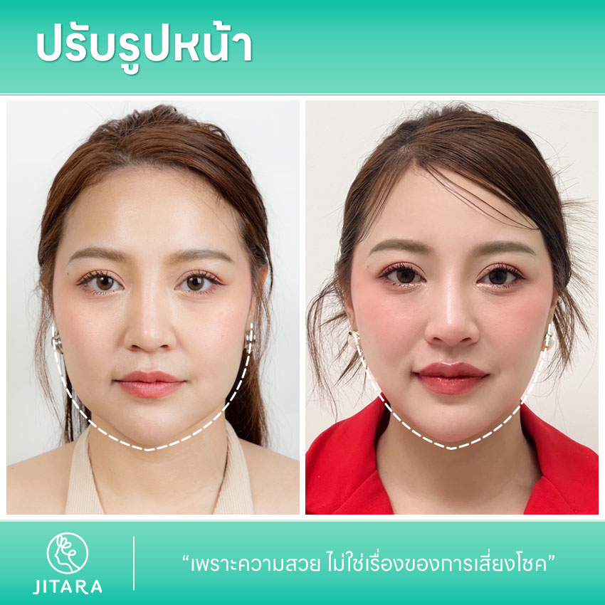 การปรับรูปหน้า | jitaraclinic