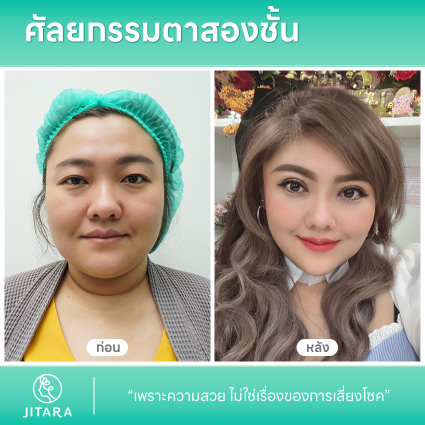 รีวิวทำ ศัลยกรรมตาสองชั้น