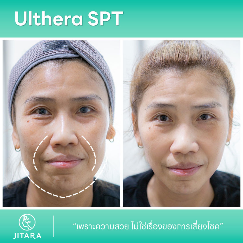 รีวิว Ulthera SPT | jitaraclinic
