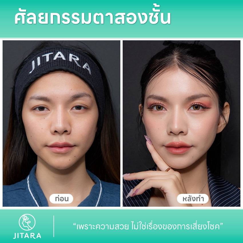 ศัลยกรรมตาสองชั้น